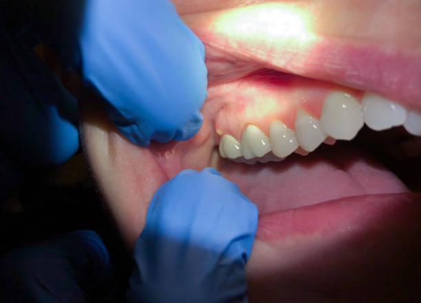 Best Knocked-Out Tooth (Avulsed Tooth) Treatment in Huguley, AL